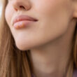 HSV, herpes, cold sores