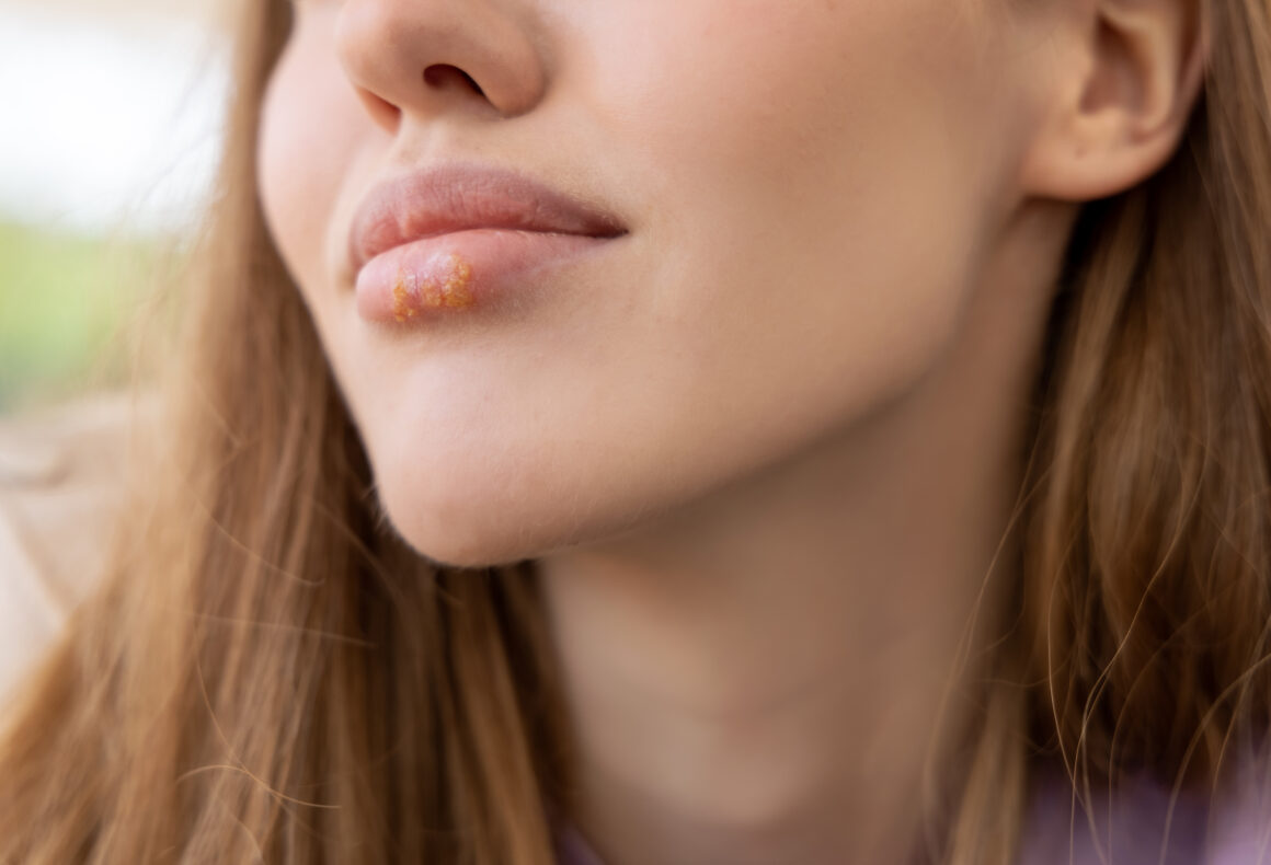 HSV, herpes, cold sores