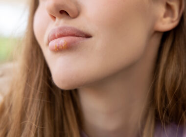 HSV, herpes, cold sores