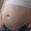 pregnancy and hernia, umbilical hernia, c-section