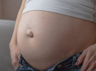 grossesse et hernie, hernie ombilicale, césarienne
