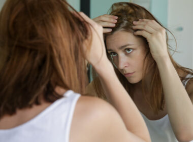 pérdida de cabello hormonal, pérdida de cabello, PMOS, perimenopausia