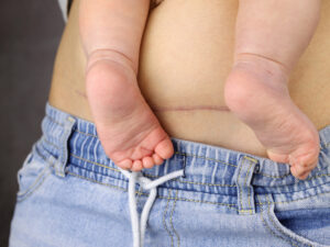 c-section therapy, postpartum, occupational therapy, physical therapy