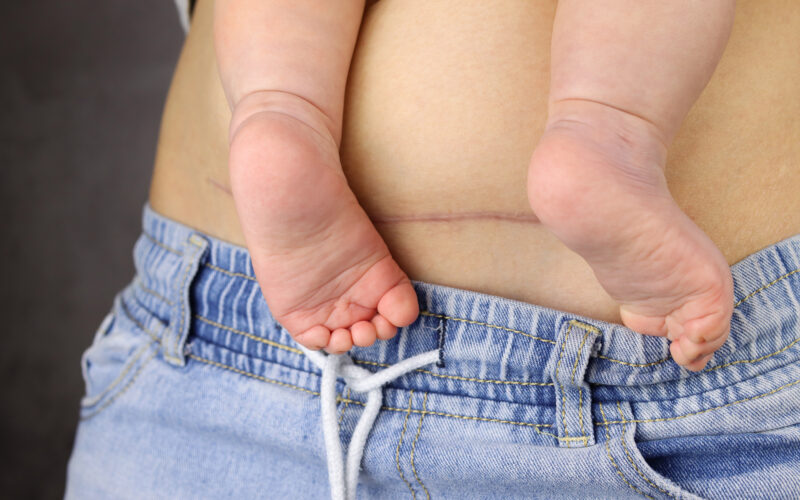 thérapie de césarienne, post-partum, ergothérapie, kinésithérapie