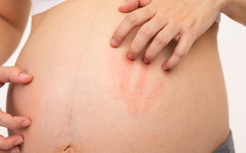 skin changes during pregnancy, linea nigra during pregnancy, melasma during pregnancy, PUPPP, pregnancy acne, varicose veins pregnancy, pruritic urticarial papules and plaques of pregnancy, prurigo of pregnancy, pemphigoid gestationis